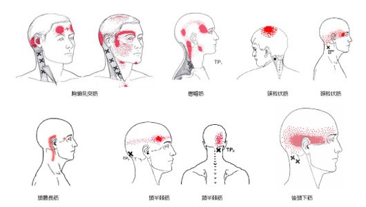 鍼灸・整骨院で緩和できる頭痛と症状